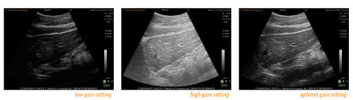 ultrasound gain settings