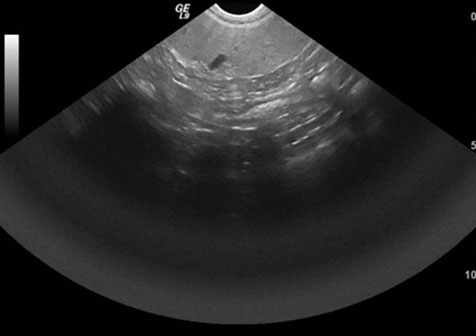 ultrasound spleen too much depth